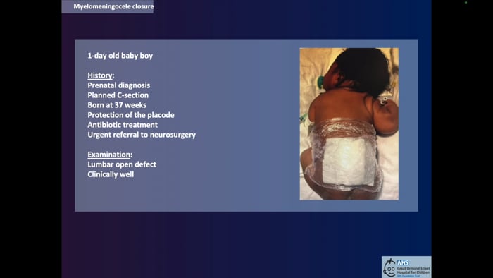 Postnatal Closure of Myelomeningocele