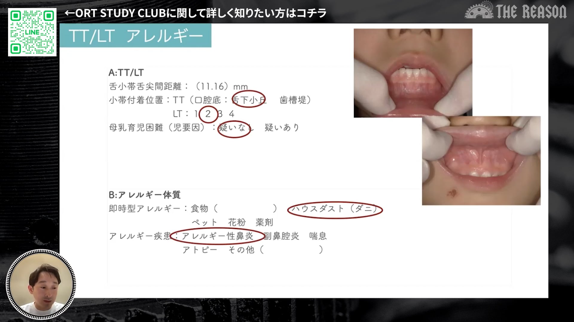 第17回 上下顎狭窄の原因を探った症例