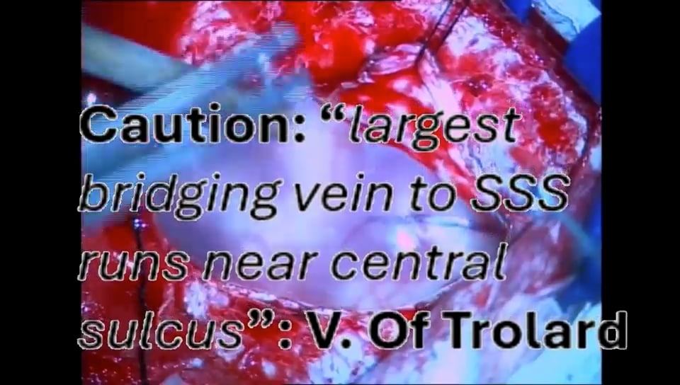 Cysto Ventriculostomy for Shunt Induced Arachnoid Cyst