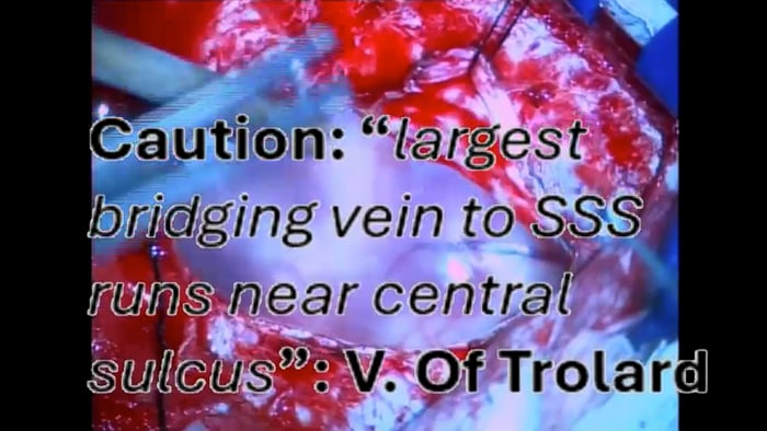 Cysto Ventriculostomy for Shunt Induced Arachnoid Cyst