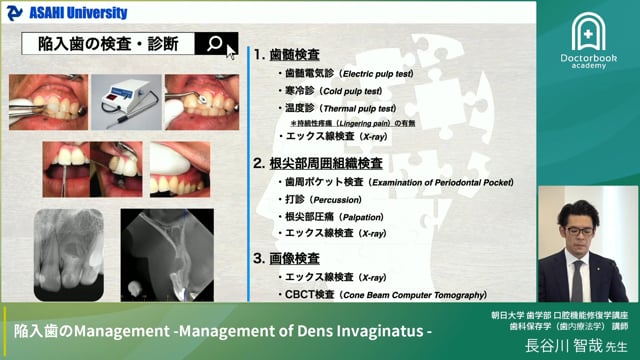陥入歯の診断とマネジメント：精密検査で確実な治療を