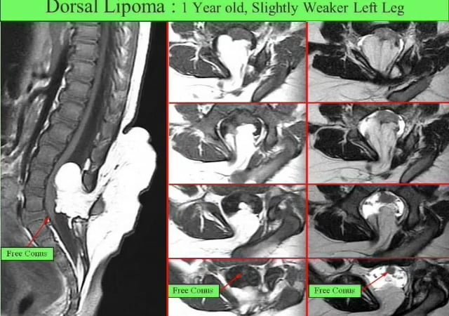 Total Resection of Dorsal Spinal Lipoma