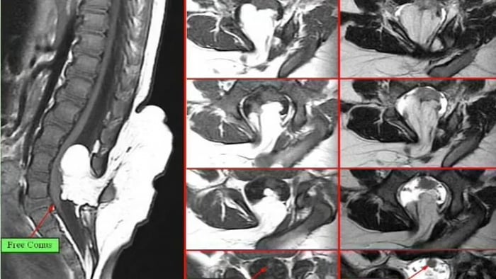 Total Resection of Dorsal Spinal Lipoma