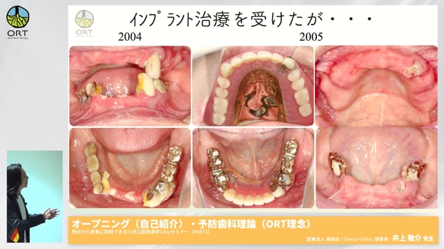 オープニング・予防歯科理論（ORT理念）#1