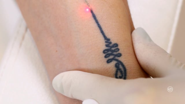 Picosecond Laser Tattoo Removal