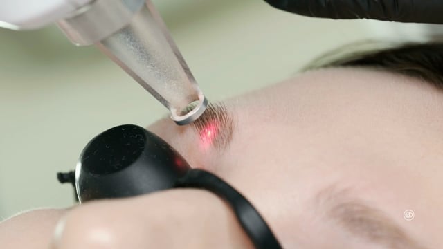 Picosecond Laser Tattoo Removal