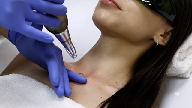 Picosecond Laser Tattoo Removal