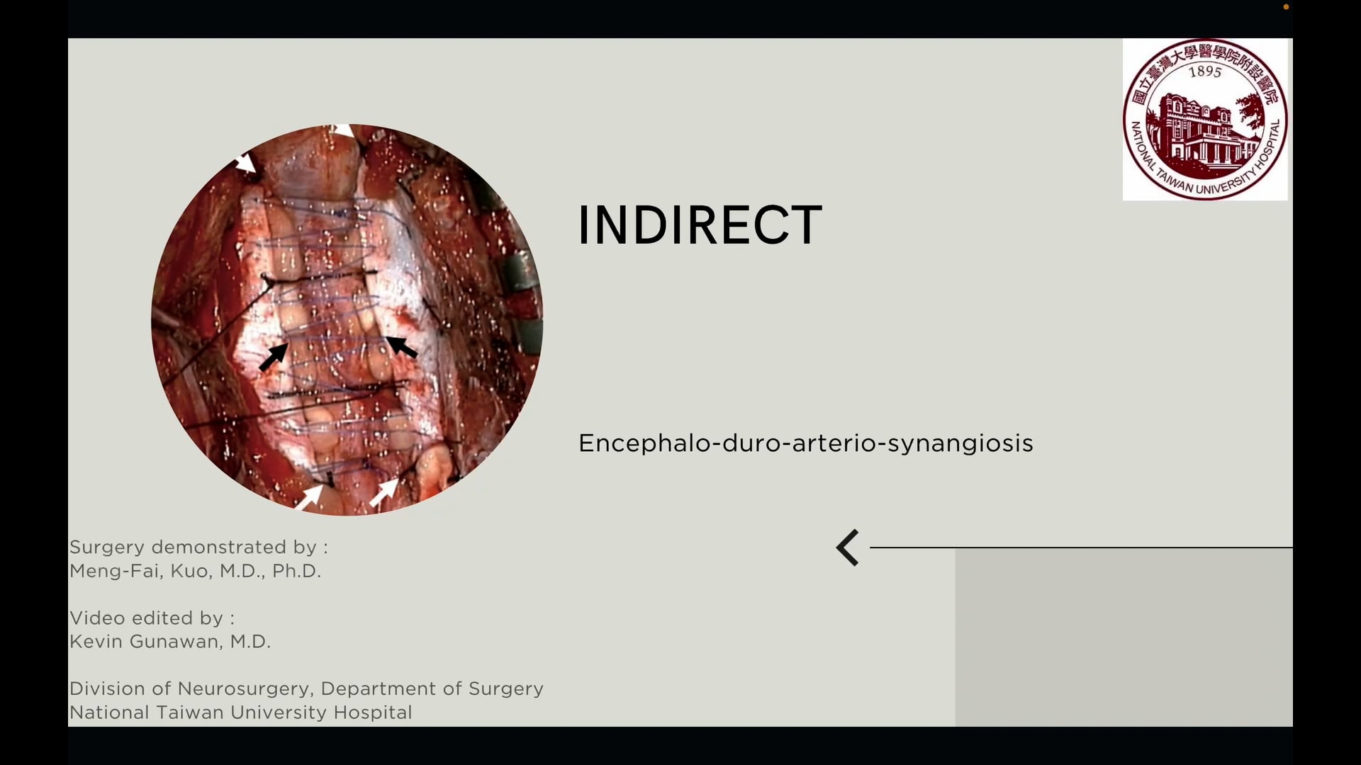 Indirect Revascularization of Moyamoya Disease: Encephalo-Duro-Arterior-Synangiosis and Dural Inversion
