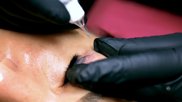 Non-Laser Tattoo Removal