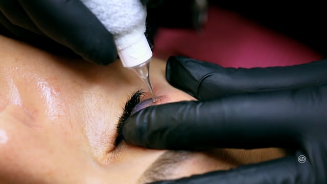Non-Laser Tattoo Removal