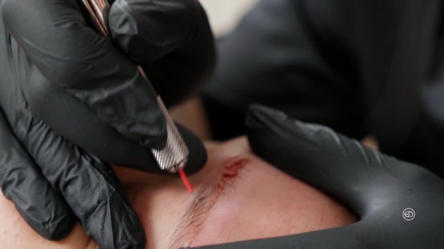 Non-Laser Tattoo Removal