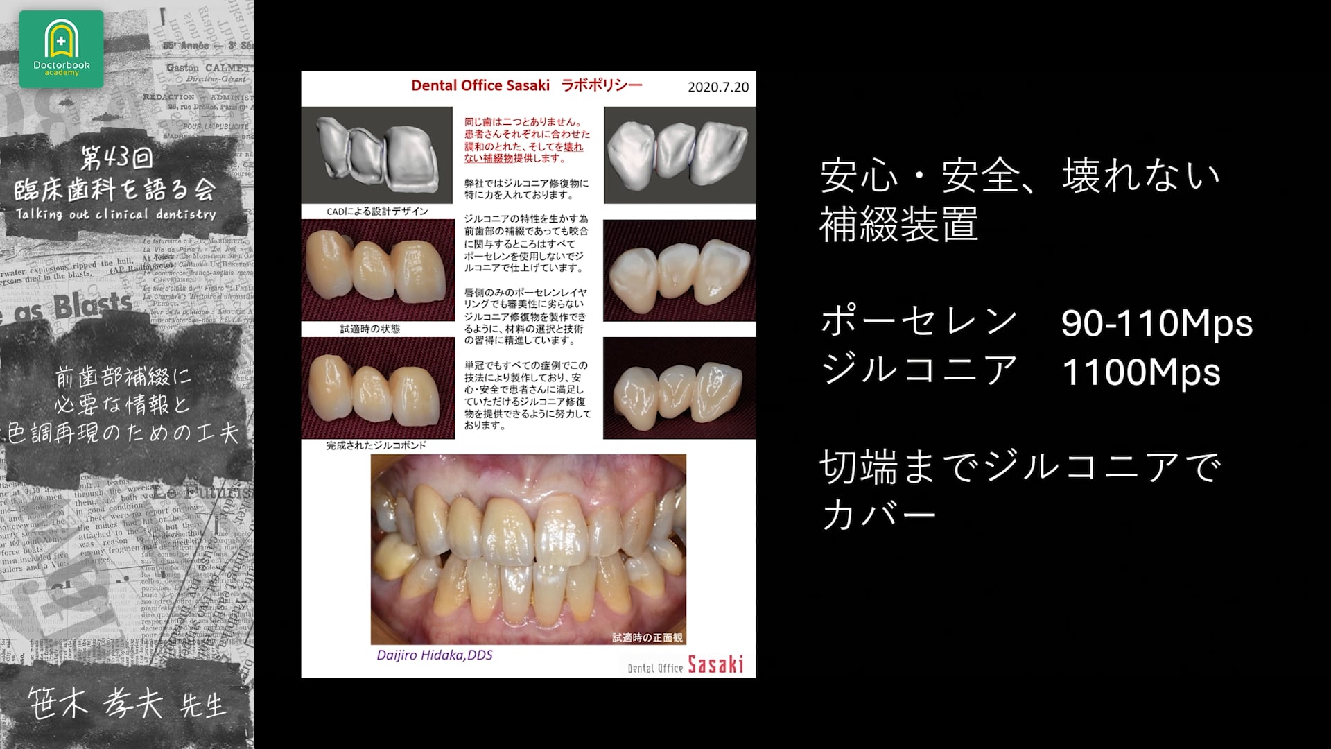 前歯部補綴に必要な情報と色調再現のための工夫 笹木 孝夫先生