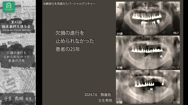 欠損の進行を止められなかった患者の25年 壬生秀明先生