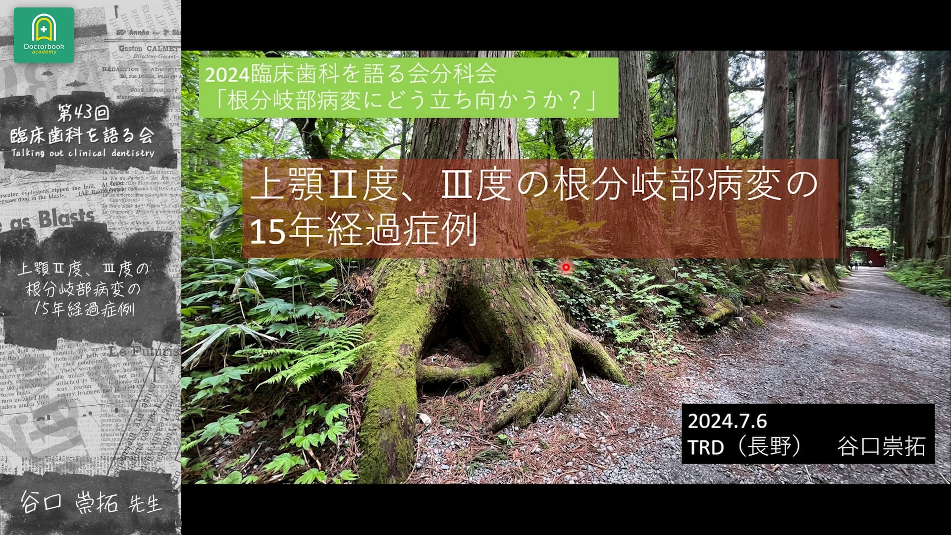 上顎Ⅱ度、III度根分岐部病変の15年経過症例 谷口崇拓先生