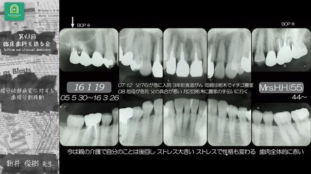 根分岐部病変に対する歯根分割移動 新井俊樹先生