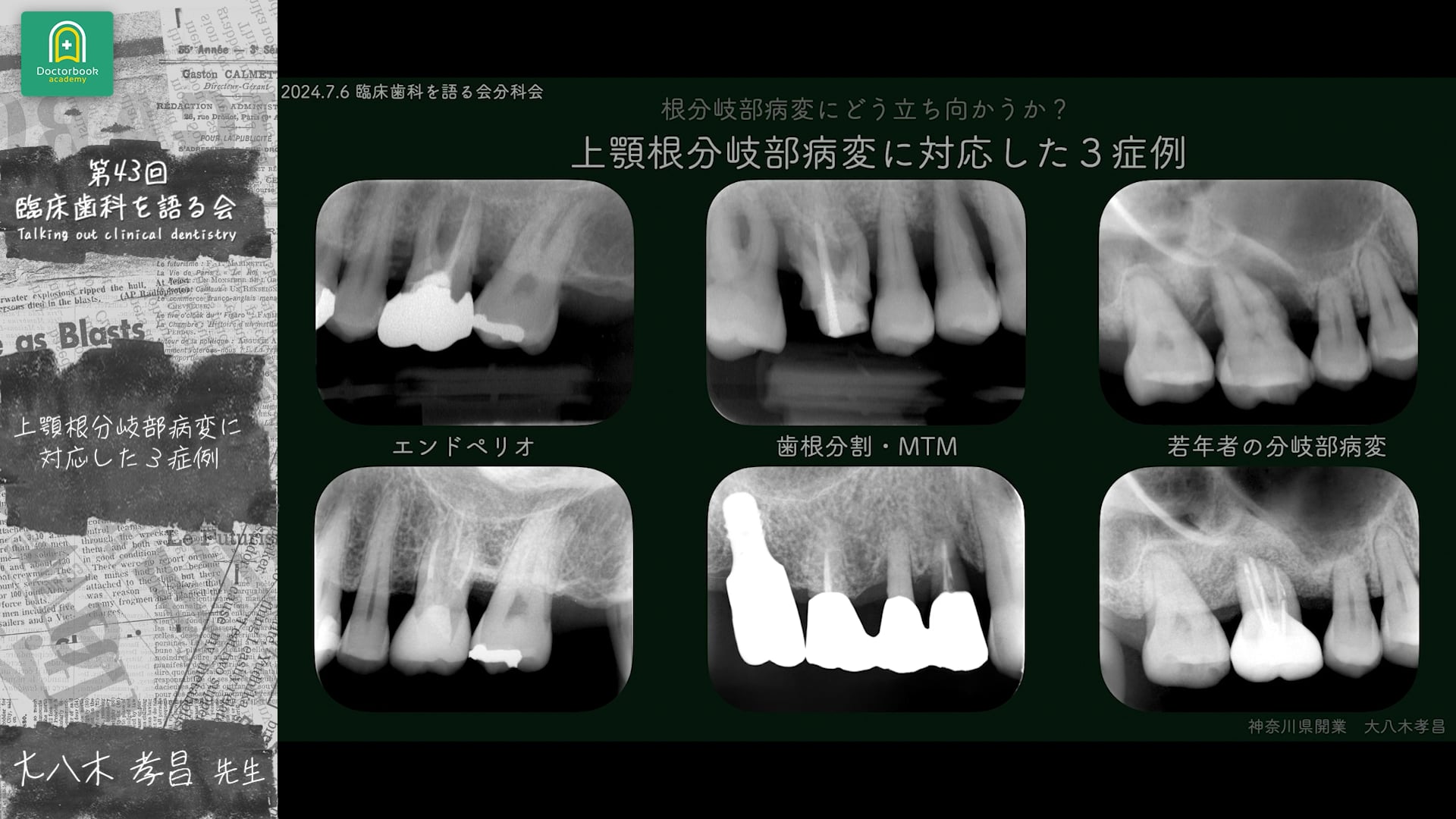 上顎根分岐部病変に対応した3症例 大八木孝昌先生