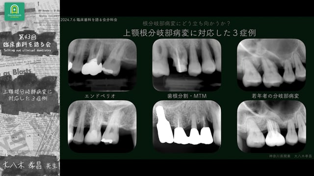 上顎根分岐部病変に対応した3症例 大八木孝昌先生｜ 第43回 臨床歯科を語る会 分科会【根分岐部病変にどう立ち向かうか？】【期間限定！D＋ または みんプレにご契約の方は視聴無料】