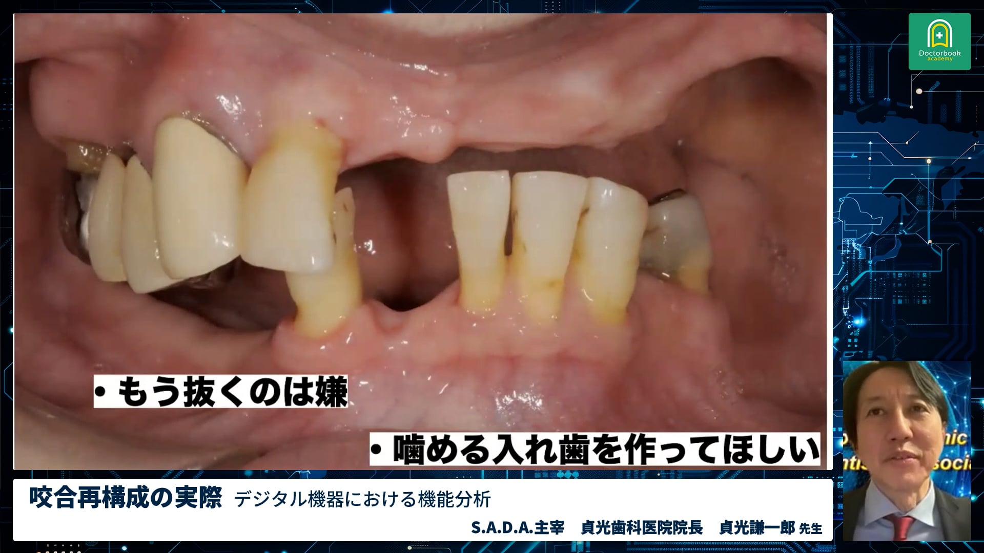 咬合再構成の実際 Digital機器における機能分析｜全顎治療の最前線"カッティングエッジ" 教育講演