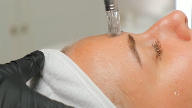 Eye Designer, microneedling, micro-needling, micro needling, Soin Du Visage, soins du visage, skincare, visage, Anti-âge, Peau, acné, eau sèche, Peau grasse, Peau sensible, Philing, cicatrices d'acné,