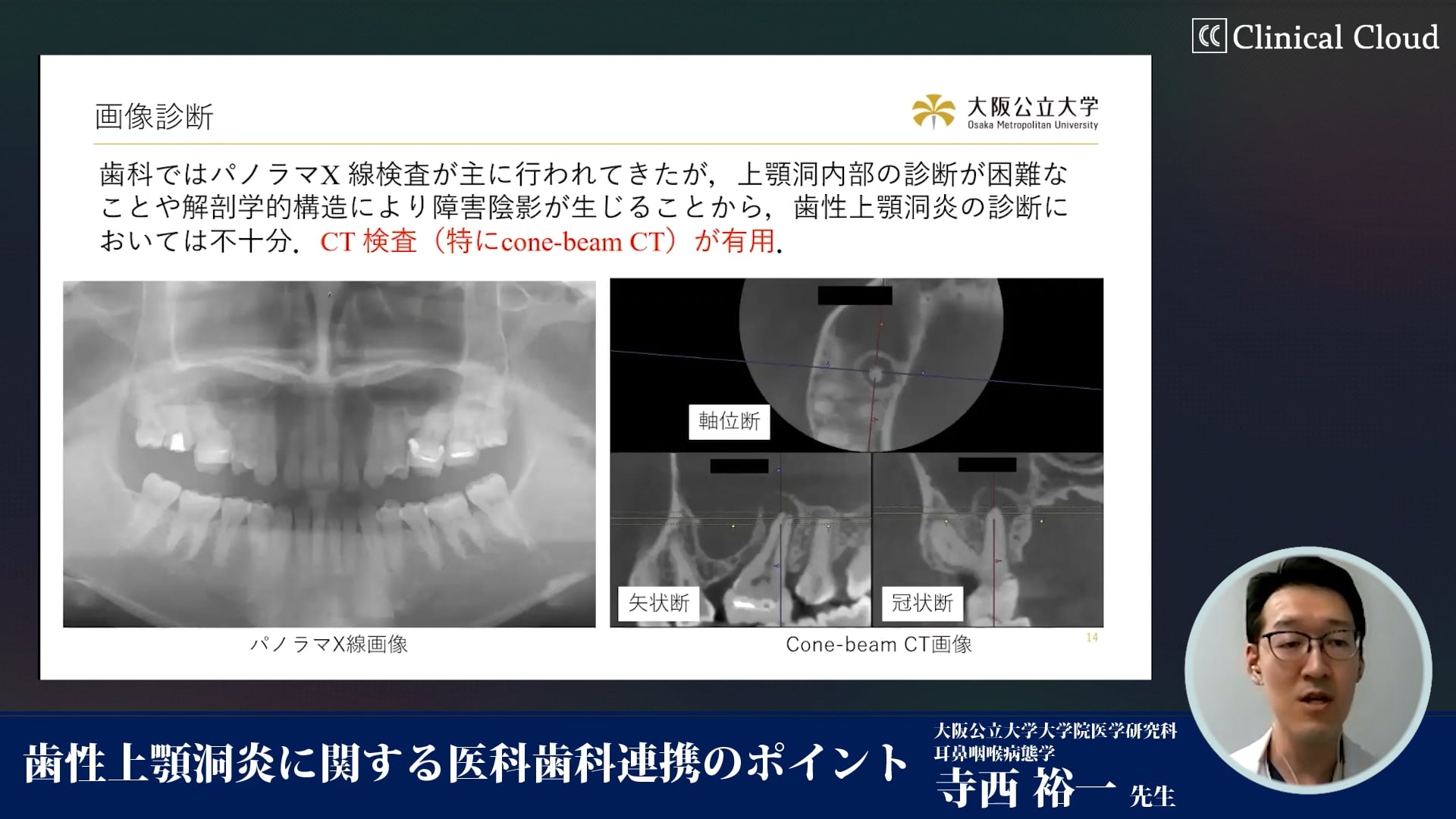  臨床知見録_レントゲン_歯性上顎洞炎の診断