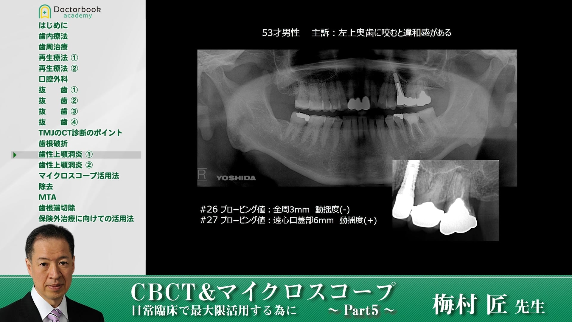  臨床知見録_レントゲン_上顎洞病変でのCTの有用性