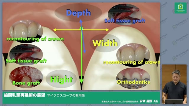 歯間乳頭再建の展望 - マイクロスコープの有用性