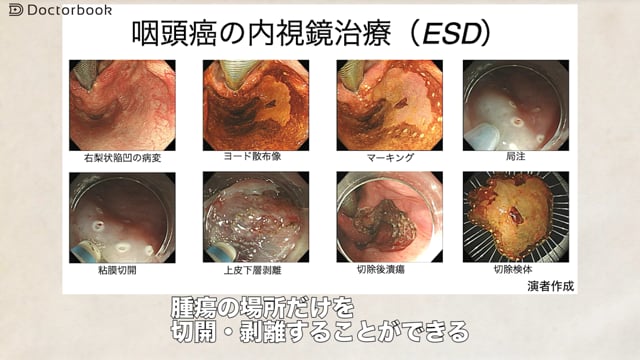 表在咽頭がんpart2～表在咽頭がんの治療法：内視鏡的粘膜下層剥離術（ESD）とは？～