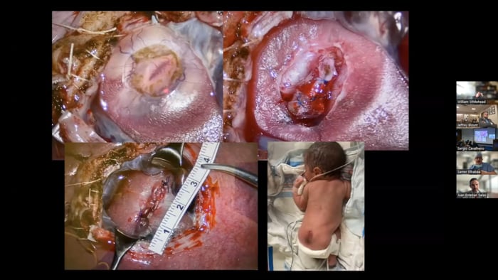 Fetal In-Utero Neurosurgical Repair of Myelomeningocele and Myeloschisis:  does technique matter?