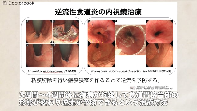 胃食道逆流症 part3～胃食道逆流症の内視鏡的治療について～