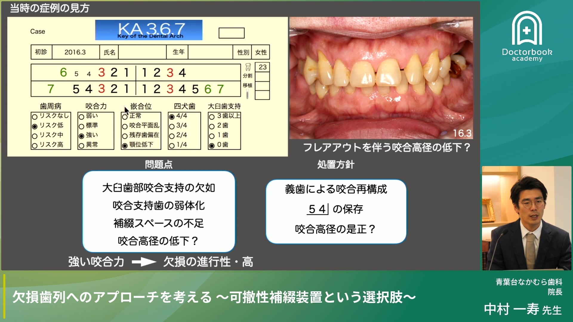 咬合力が強い欠損歯列への考え方