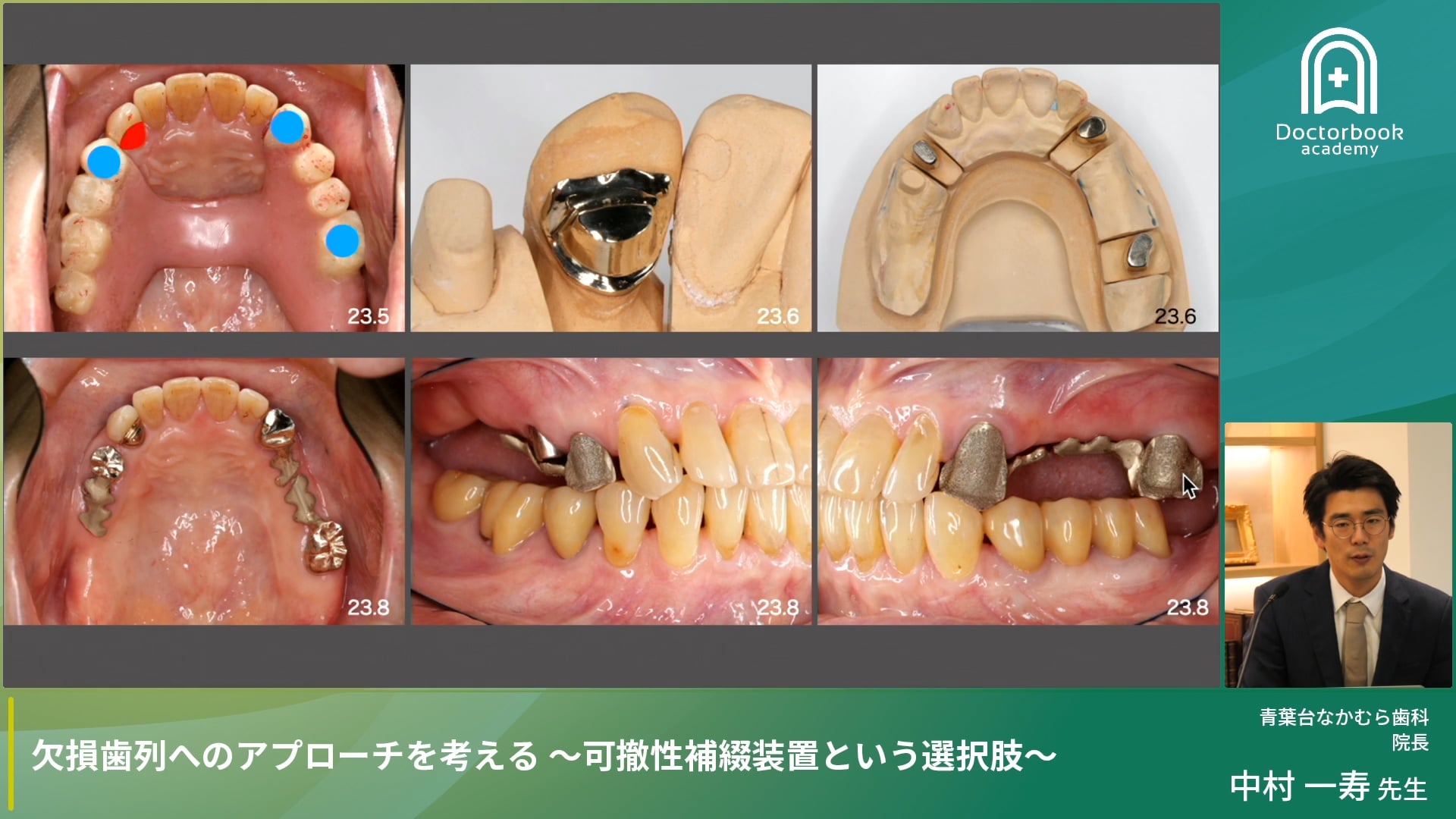 アンテリアガイダンスの付与と義歯設計の着眼点