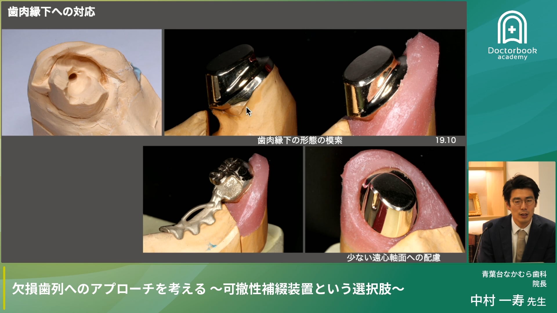 欠損補綴の考え方〜加圧と受圧のバランスとテレスコープデンチャー〜