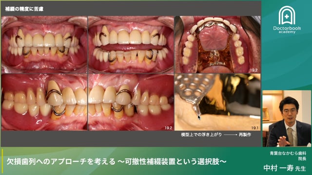 キーとなる歯を考える〜咬合崩壊を止めるための一次固定と二次固定〜							