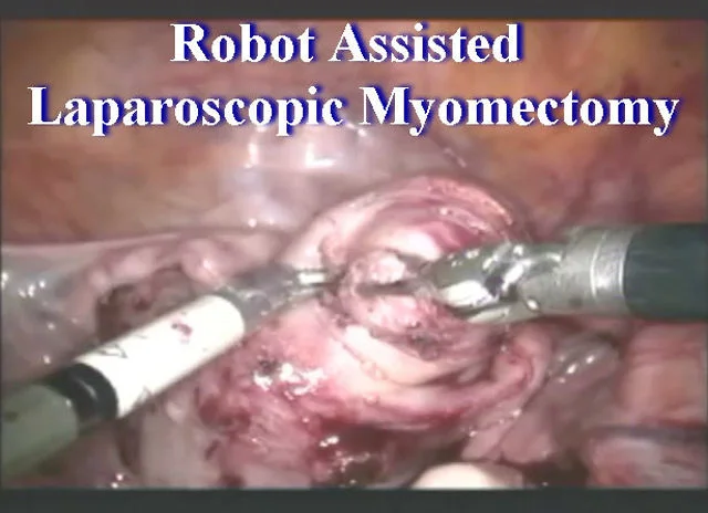 laparoscopic myomectomy procedure