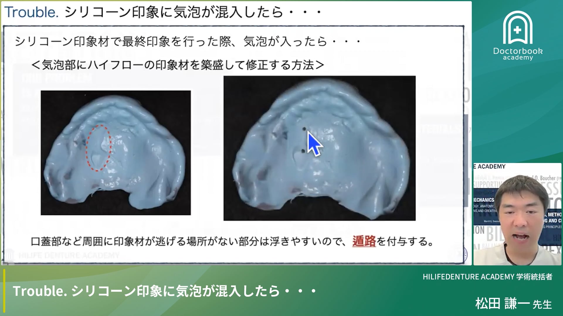 Trouble. シリコーン印象に気泡が混入したら・・・