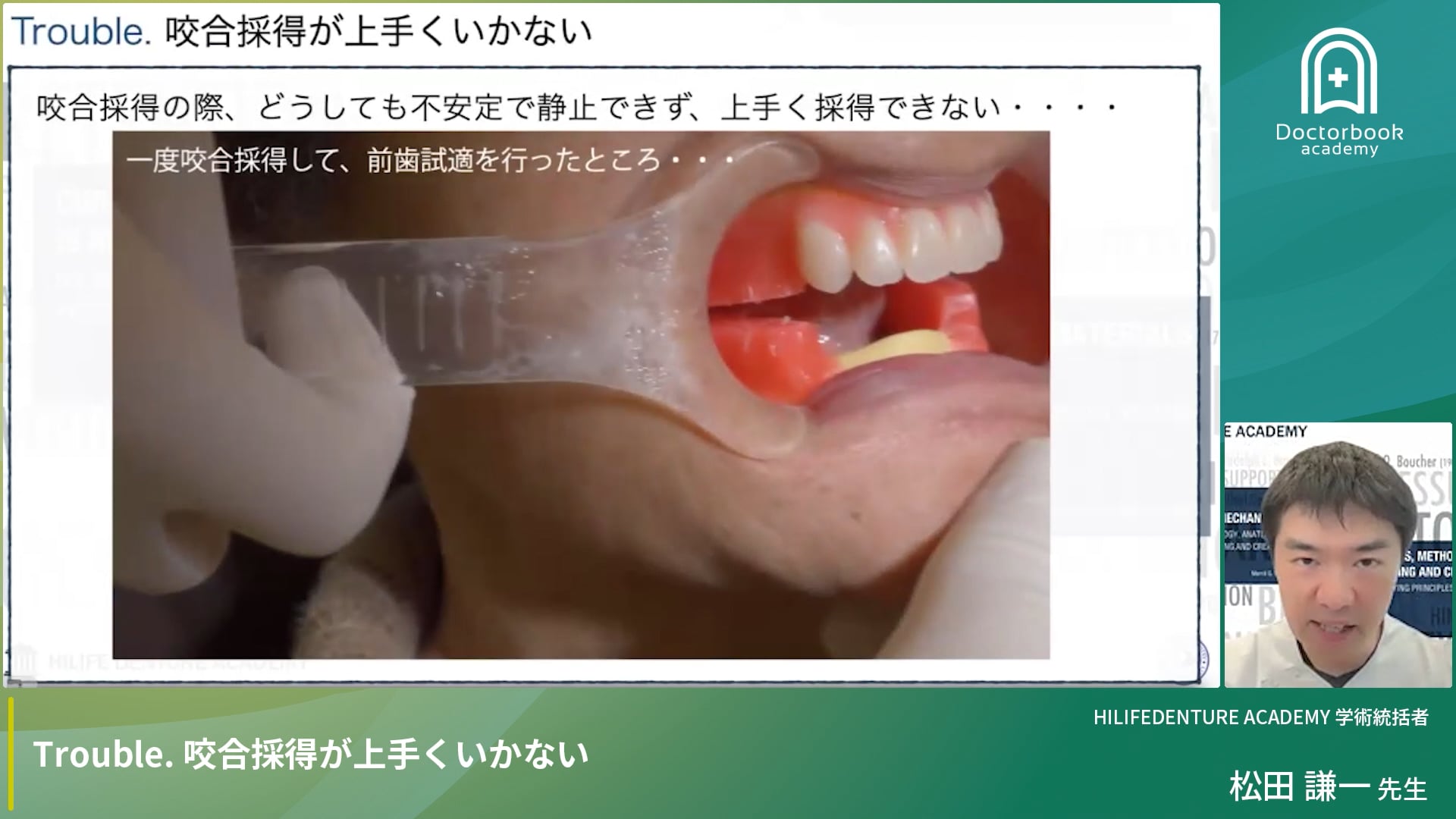 Trouble. 咬合採得が上手くいかない