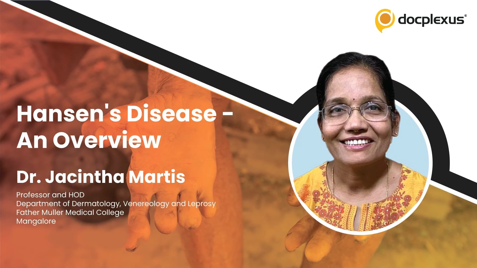 Hansen's Disease – An Overview