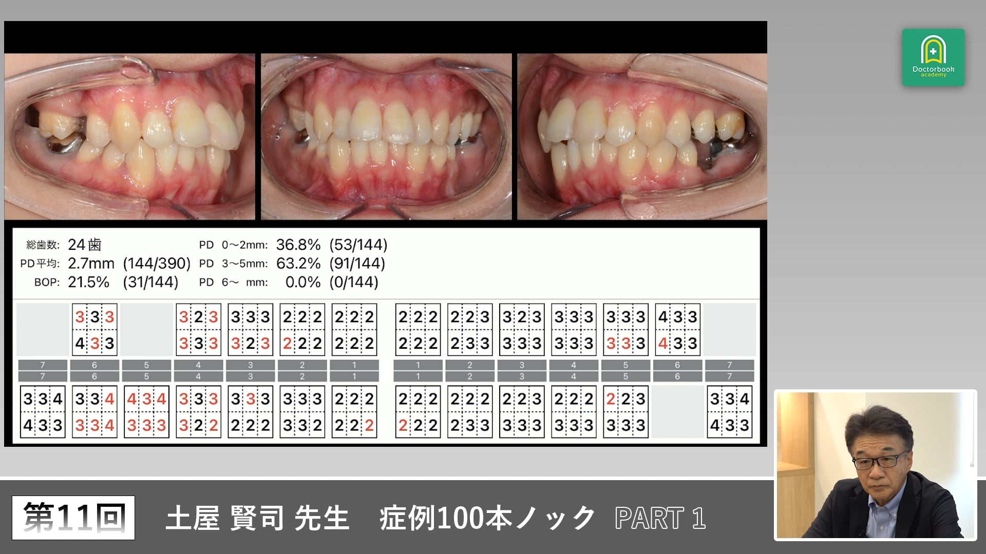下顎臼歯部疼痛症例から学ぶパノラマ診断と治療計画の立て方 #1