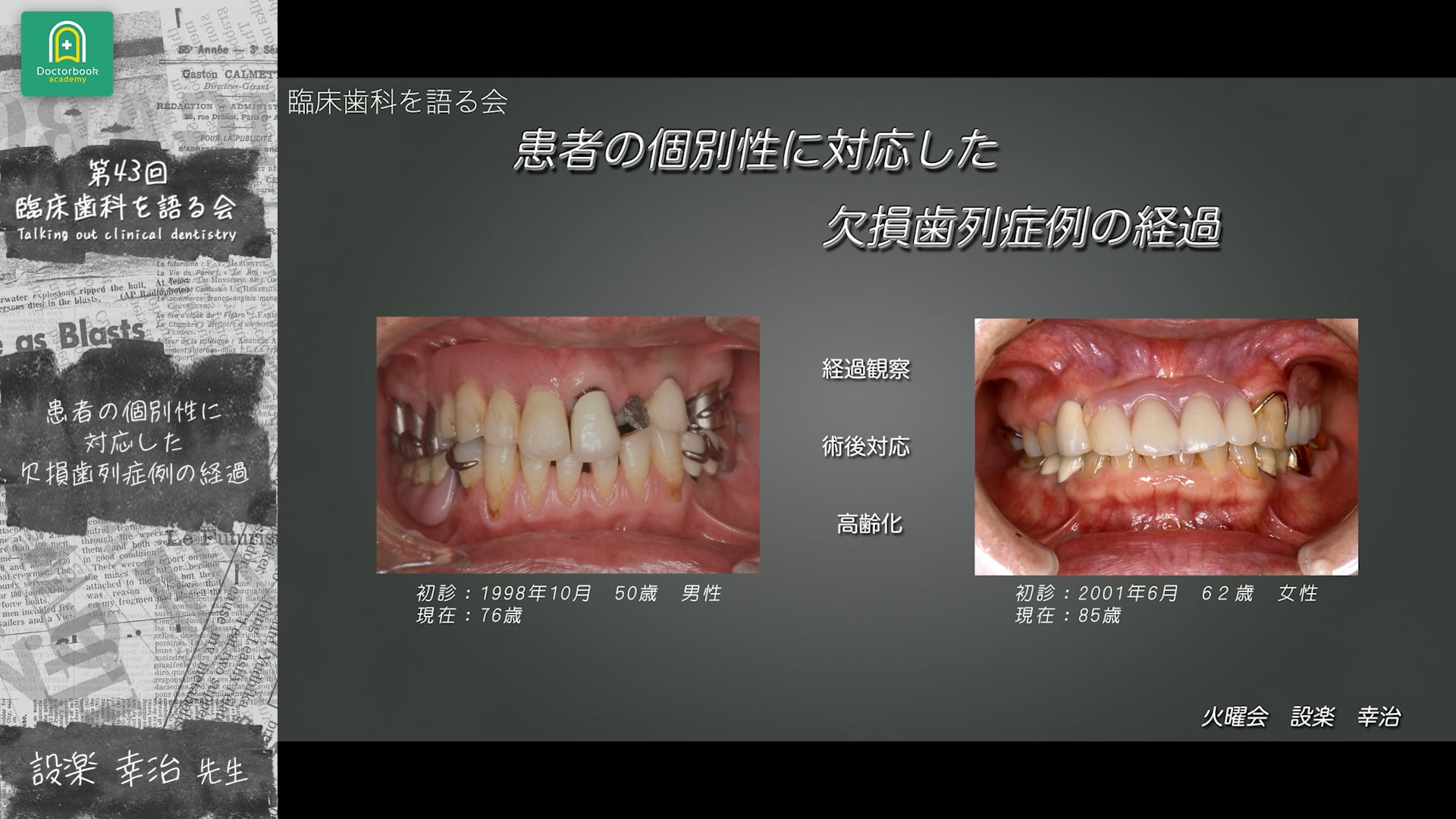 患者の個別性も対応した欠損歯列症例の経過 後半 設楽幸治先生