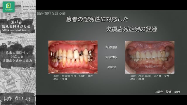 患者の個別性も対応した欠損歯列症例の経過 前半 設楽幸治先生