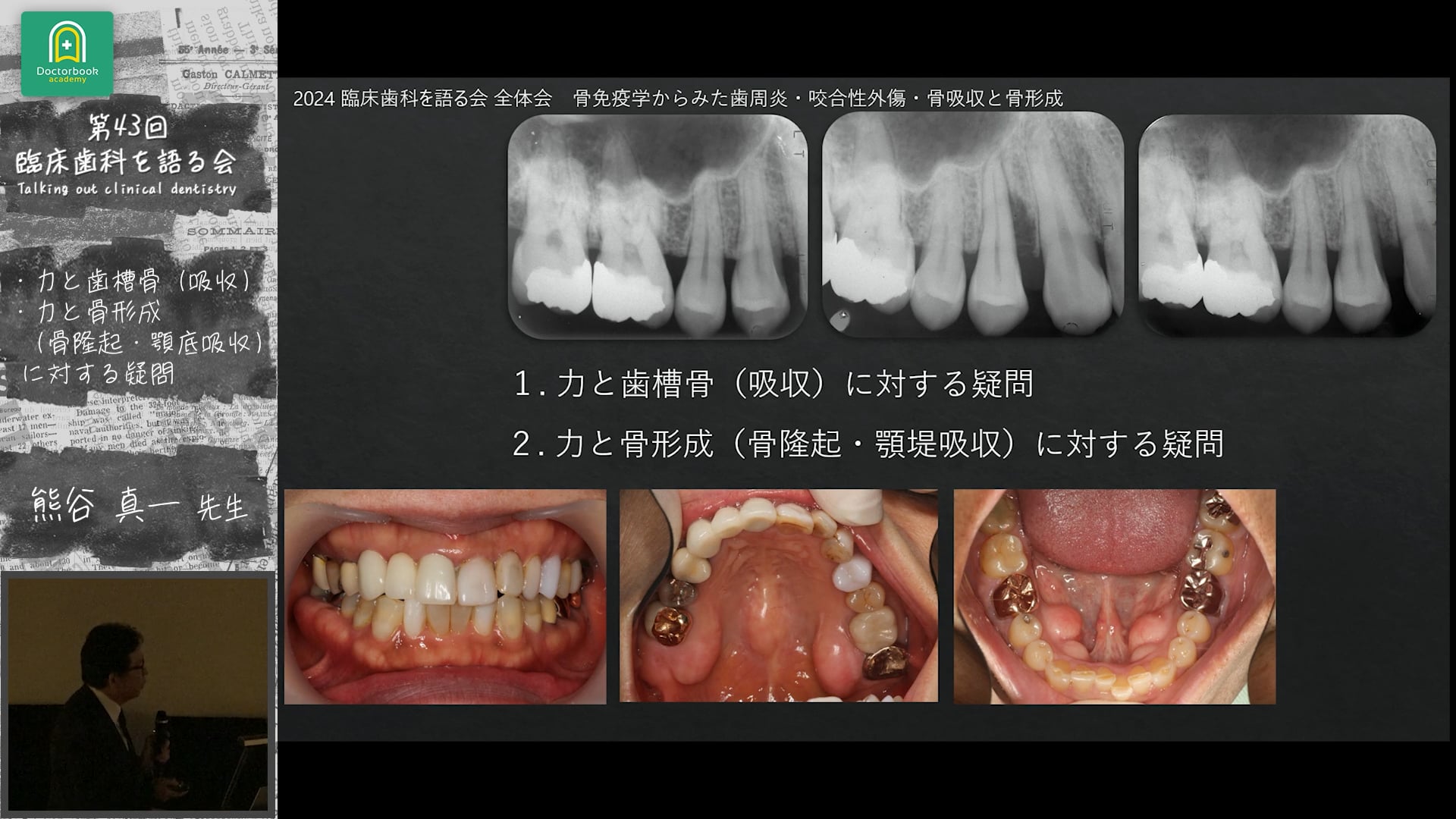 塚崎先生にお聞きしたいこと：力と歯槽骨(吸収)、力と骨形成(骨隆起・顎底吸収)に対する疑問 熊谷真一先生