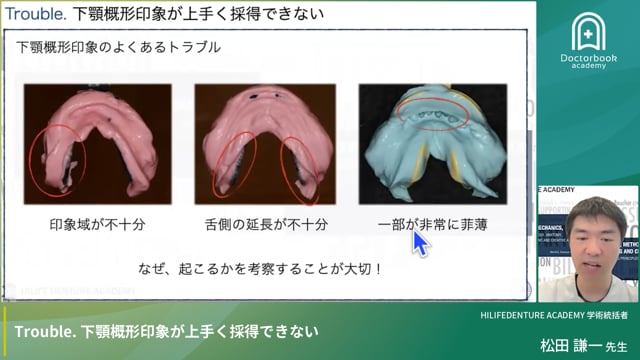 Trouble. 下顎概形印象が上手く採得できない