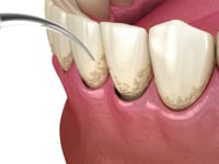 Laser Treatment Overview