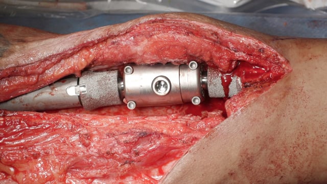 Revision Knee Arthrodesis with Distal Femur Endoprosthesis