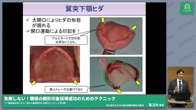 失敗しない！顎堤の概形印象採得成功のためのテクニック