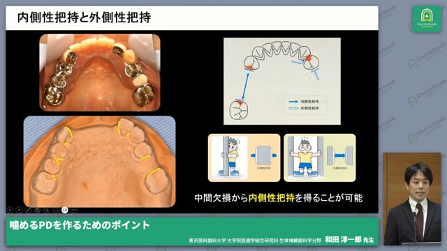 噛めるPD（パーシャルデンチャー）を作るポイント