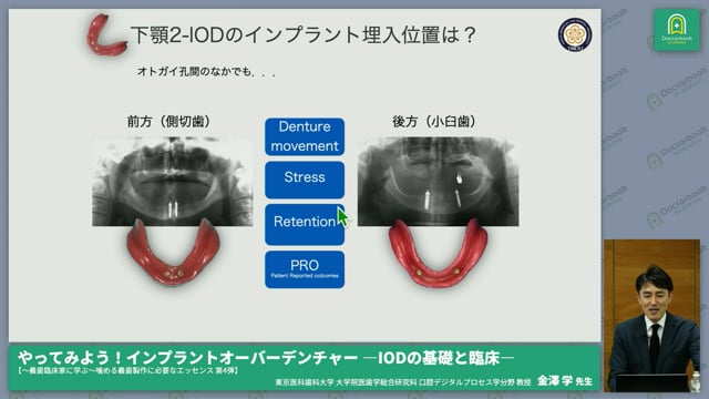 やってみよう！インプラントオーバーデンチャー ―IODの基礎と臨床―