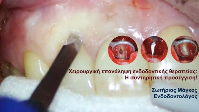 Χειρουργική επανάληψη ενδοδοντικής θεραπείας: Η συντηρητική προσέγγιση!