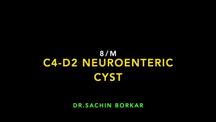 Final Neuroenteric Cyst Excision