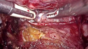 TÉCNICA DE DERIVACIÓN URINARIA INTRACORPÓREA LAPAROSCÓPICA